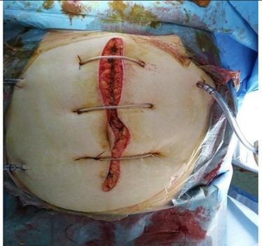 Closure of abdomen with skin retention suture and multiple drains.