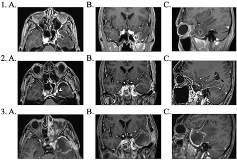 1. Pre-operative contrast enhanced brain MRI: (a) T1 axial view with enhancing lesion; (b) T1 coronal and (c) T1 sagittal. 2. First post-operative contrast enhanced brain MRI showing resection of lesion: (a) T1 axial. Arrow: dural enhancement of sphenoid sinus; (b) T1 coronal and (c) T1 sagittal. 3. Second post-operative contrast enhanced brain MRI following endoscopic re-resection: (a) T1 axial; (b) T1 coronal and (c) T1 sagittal.