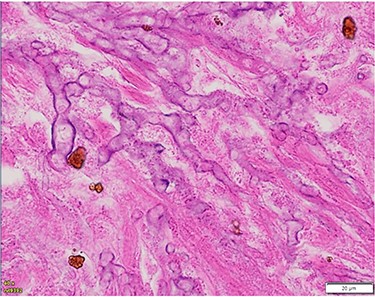 Histopathology of left temporal lobe lesion resembling zygomycete but later confirmed A. fumigatus.