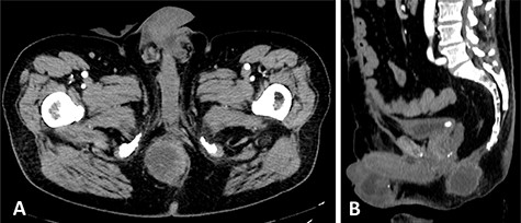 Preoperative CT that documents the absence of a clear cleavage plane between the neoplasm and the urethra in axial (A) and sagittal (B) scans.
