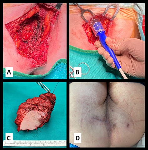 (A) Operative detail with partial removal of the pelvic floor muscle infiltrated by the neoplasm; (B) application of electrical stimulation by penetrating the electrodes for 1.5 cm; (C) surgical specimen, reference thread on the deep margin near the base of the penis and (D) surgical site eight months after surgery.