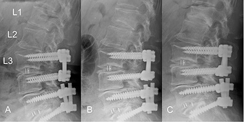 Time course of a vertebral fracture at L1. (A) Radiographic image obtained just before the vertebral fracture occurred. (B) The vertebral fracture had occurred at L1 4 months before surgery. (C) Radiographic image obtained when the patient presented with symptoms of radiculopathy shows no apparent posterior slip of the L2 vertebra. The L1 vertebral body was deformed into a wedge shape.