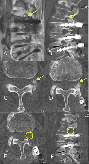 Magnetic resonance and computed tomography (CT) images acquired at the time of onset of radiculopathy. (A) Sagittal T1-weighted magnetic resonance image showing moderate foraminal stenosis at the L2–L3 level. (B) Sagittal CT image showing ossification of the ligamentum flavum protruding into the foramen. (C, D) Axial CT image showing OLF in the capsular portion. (E, F) Postoperative CT image confirming adequate removal of the ossification of the ligamentum flavum.