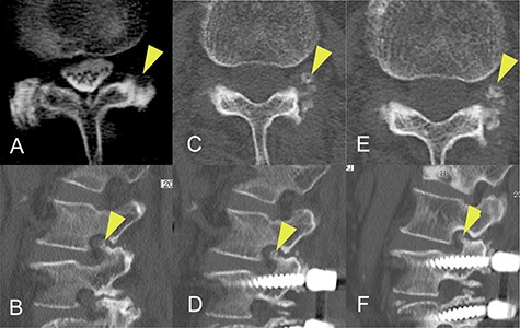 Progression of ossification of the ligamentum flavum (OLF) on computed tomography (CT) images obtained before onset of radiculopathy. (A) OLF was not found on a CT scan obtained 8 years earlier. (B) A CT image obtained 20 months earlier shows a small isolated area of OLF in the foramen. (C, D) A CT image acquired 4 months earlier shows that the area of OLF had grown slightly and was integrated with the superior articular process. (E, F) A CT image obtained at the time of surgery shows further expansion of OLF.