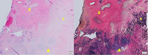 (A) Hematoxylin and eosin-stained micrograph showing chondrocytes near the area of ossification (hash). Formation of bone in hyaline cartilage is indicated by osteoblasts (triangle). There was no cartilage cap, as would be found in osteochondroma. (B) Elastica van Gieson-stained micrograph showing sparse and degenerated elastic fibers in the ligamentum flavum.