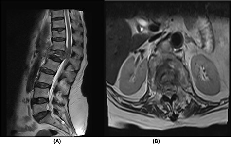 (A) T2-weighted sagittal lumbar spine MRI demonstrating a pathological fracture of L1 with spinal canal and neural foramina stenosis and cord edema and epidural and prevertebral soft tissue components. (B) T2-weighted axial lumbar spine MRI of the corresponding level of L1 vertebral body.