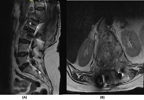 (A) T2-weighted sagittal spine MRI demonstrating changes at the thoracolumbar spine with previous decompression for pathological fracture of L1 vertebra. There is interval progression of the disease with a soft tissue mass at the previous site extending to the prevertebral and epidural spaces, compressing the neural element. (B) T2-weighted axial spine MRI of the corresponding level of L1 vertebral body.
