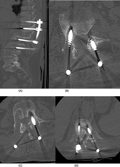 (A) Sagittal spine CT demonstrating a burst fracture involving L1 vertebral body with retropulsion of fragments and epidural soft tissue mass indenting the conus medullaris at the level of T12–L1. (B) Axial spine CT of the corresponding level of L2 vertebral body. (C) Axial spine CT of the corresponding level of L3 vertebral body. (D) Axial spine CT of the corresponding level of T11 vertebral body.