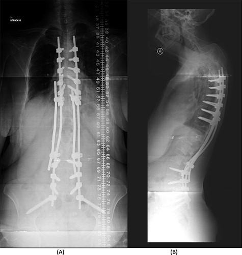 (A) AP lumbar spine X-ray demonstrating the bridging technique. (B) Lateral spine X-ray showing the bridging technique sparing the infected area.