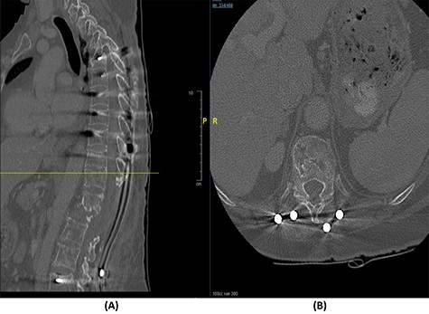 (A) Sagittal spine CT demonstrating healed bone and re-ossification of T11-L3. (B) Axial spine CT of the corresponding level of T11 vertebral body.
