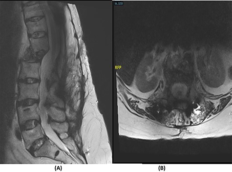 (A) T2-weighted sagittal spine MRI demonstrating changes at the thoracolumbar spine with complete resolution of infection and no cord compression. (B) T2-weighted axial spine MRI of the corresponding level of L1 vertebral body.