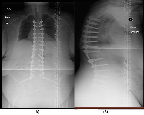 (A) AP lumbar spine X-ray demonstrating final fixation from T5-S2-alar-iliac screws. (B) Lateral spine X-ray.