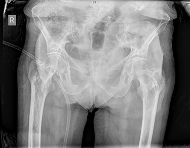 Pelvic X-ray on initial admission demonstrated no features of fracture, bowel obstruction or incarcerated hernia.