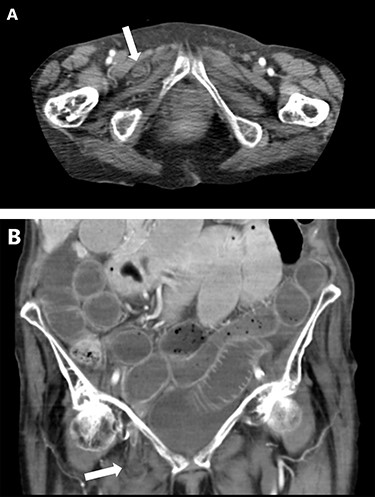 CT abdomen showing small bowel obstruction with right-sided obturator hernia (white arrow) on axial (A) and coronal (B) views.