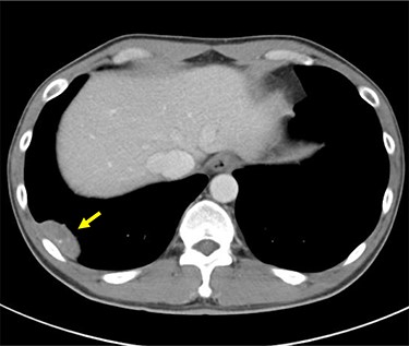 Preoperative enhanced CT scan demonstrates a well-defined 44 mm solid nodule with calcification in the right lateral thoracic cavity (yellow arrow). CT: computed tomography.