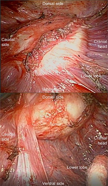 The nodule is observed between the visceral pleura and parietal pleura.