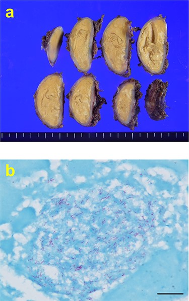 (a) Macroscopically, encapsulated chronic granulomatous with caseous necrosis. (b) Ziehl–Neelsen staining (1000× magnification) showing red bacillus. Scale bar = 10 μm.
