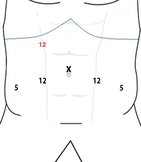 Trocars arrangement.