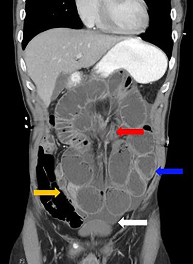 Dilated loops of small bowel (blue arrow), oedematous mesentery (suggestive of closed-loop obstruction; red arrow), free fluid (evidence of CA; white arrow) and collapsed small bowel (orange arrow)
