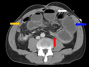 Dilated loops of small bowel (blue arrow), transition point (red arrow), free fluid (evidence of CA; white arrow) and collapsed small bowel (orange arrow).