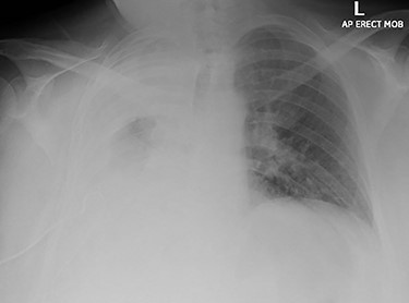 Chest X-ray imaging of the patient during admission; a wide right sided pleural effusion is depicted.