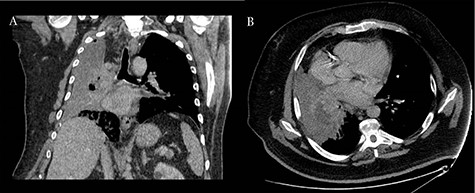 Coronal (A) and axial (B) CT scans revealing consolidation of the right upper lobe with a 6-cm lesion in hilum; the upper and middle lobe bronchus cannot be reliably visualized and complete occlusion of the right lower lobe bronchus is present.