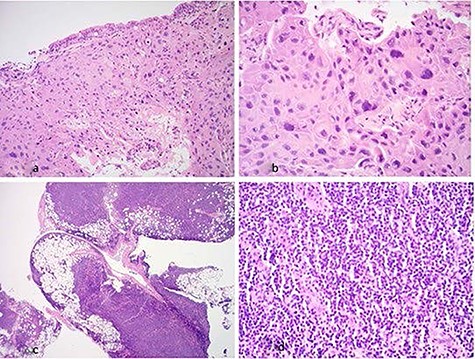 (a) Hematoxylin & eosin (×20 magnification): low-power view showing bronchial mucosa extensively infiltrated by tumor; (b) hematoxylin & eosin (×40 magnification): bronchial mucosa infiltrated by sheets of malignant squamous cells; (c) hematoxylin & eosin (×2 magnification): low-power view of pleura showing dense lymphoid infiltrate which involves adipose tissue; (d) hematoxylin & eosin (×40 magnification): high-power view of pleura showing sheets of small lymphoid cells.