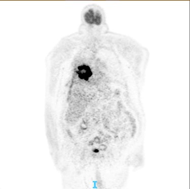 PET scan: there is no obvious cervical, supraclavicular, mediastinal, hilar and axillary lymphadenopathy.