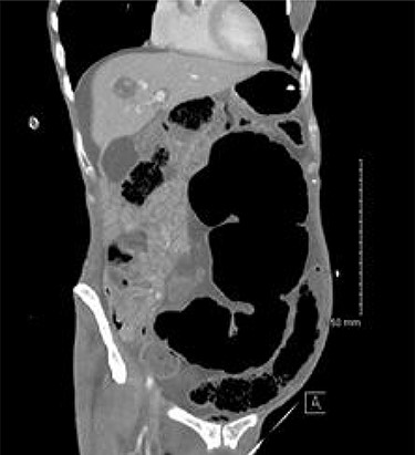 CT appearance suggestive of SV with collapsed right colon and no appreciable CV.