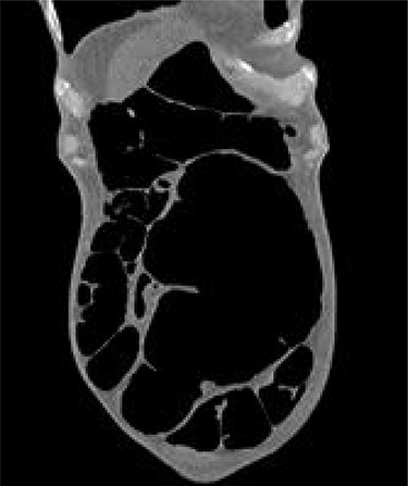 Grossly distended caecum on repeat CT scan.