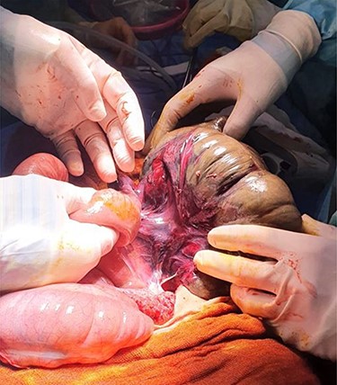 Intra-operative finding of CV with necrosis of the caecum. Long redundant sigmoid colon also evident.