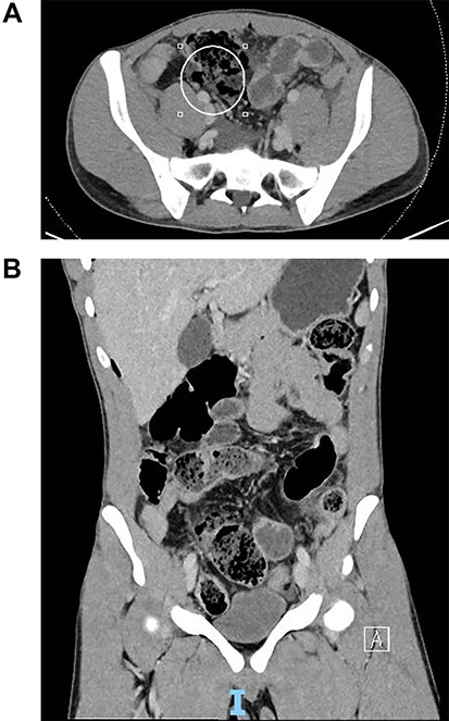 (A) Coronal slice of computed tomography (CT) image of small bowel perforation at distal ileum. (B) Sagittal slice of CT image of small bowel perforation at distal ileum.
