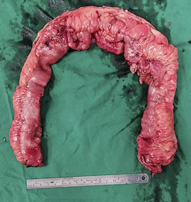 Uncut specimen of small bowel showing fat creeping.