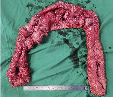 Cut specimen of small bowel showing 2 cm defect into the mesentery and another more proximal with 1 cm defect at the anti-mesentery border 3 cm away from the above 30 cm from IC valve.