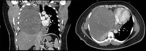 (Left to right) Coronal and axial images of 17 × 16 × 17.3 cm heterogeneous anterior mediastinal mass with compression of the right lung and left-sided mediastinal shift.