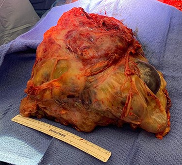 Tumor specimen. Final pathology demonstrated a mixed GCT with mostly teratoma. Weight: 4.6 kg.