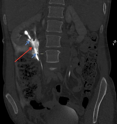 CT Urogram demonstrating extravasation of contrast. The blue arrows show the severed ends of the right inferior collecting system. The red arrow shows the contrast extravasation.