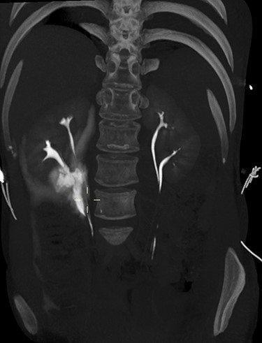 3D maximum intensity projection image of bilateral duplex kidneys and the contrast extravasation from the inferior moiety.