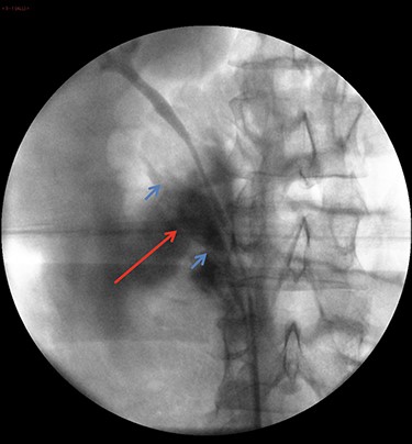Retrograde ureteropyelography of right collecting system in theatre. The blue arrows show severed ends of the right inferior collecting system. The red arrow shows the contrast extravasation.