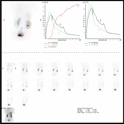 MAG 3 Renogram indicating slightly asymmetrical renal function (left better than right) and no evidence of true outflow obstruction but a mildly hypotonic right renal collecting system.