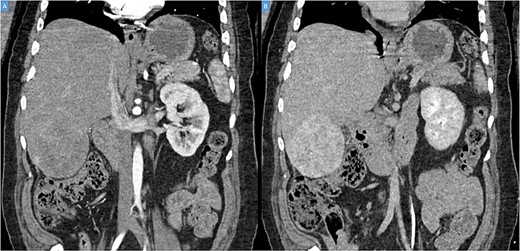 (A, B) Coronal computed tomography of the abdomen showing a large tumor on liver’s segments V–VI with heterogenous contrast enhancement.
