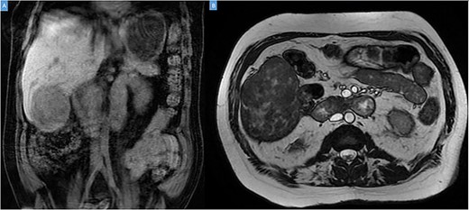 Coronal (A) and axial (B) sections of MRI showing the peripheral liver tumor.