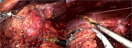 Intraoperative picture showing a bulky tumor infiltrating the liver’s segments V–VI and the right colic flexure (A). Hepatic transection with the harmonic (B).