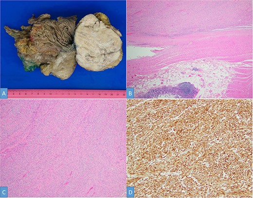 Gross examination shows a solid white-tan tumor arising from colonic wall and pushing into the liver parenchyma (A). A cellular spindle cell neoplasm can be seen arising from colonic muscular wall; H&E ×20 (B). The tumor showed no increase in cellularity, mitotic figures or foci of necrosis; H&E ×100 (C). SMA immunohistochemistry ×200 (D).