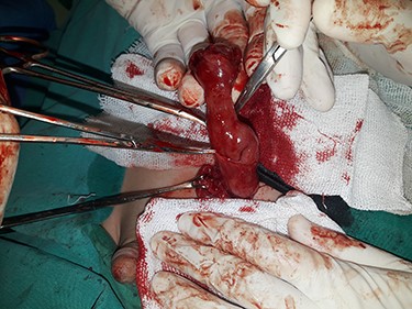 Exposing the hernia sac revealed a 5 cm MD.