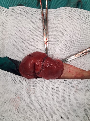 Ileoileal primary anastomosis