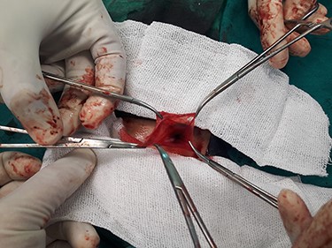 Hernia sac before ligation.