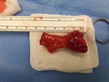 MD after resection.