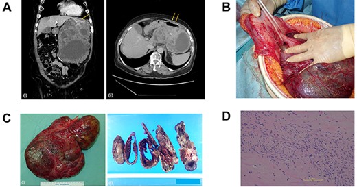 (A) Computed tomography scan of the abdomen before the primary surgery (i, coronal view; ii, axial view). The large pleomorphic mass measures 16×10×20 cm and is adjacent to the stomach (arrow). (B) Intraoperative inspection shows a large tumor pedunculated from the dorsal wall of the upper body of the stomach. (C) Postoperative specimen (i) of the gastric pedunculated GIST. The tumor shows (ii) pleomorphism of solid and cystic areas, calcification, hemorrhage, and necrosis. (D) The tumor consists mostly of spindle cells arranged in interlacing bundles and partially of epithelioid cells with severe atypia compared to usual GISTs.