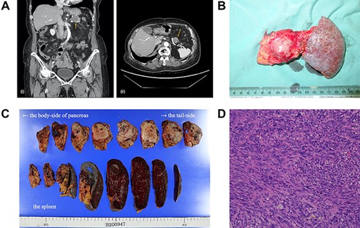 (A) A computed tomography scan of the abdomen was performed nine months after surgery. (i, coronal view; ii, axial view). A 2.2 cm mass has appeared at the anterior part of the tail of the pancreas (arrow). (B) The postoperative specimen including the recurrent tumor of pancreas from the dorsal side. (C) The tumor is solid without serosal invasion. The specimens on upper line are the pancreas, and those on lower line are the spleen. (D) The tumor cell structure shows more atypism than the original tumor.